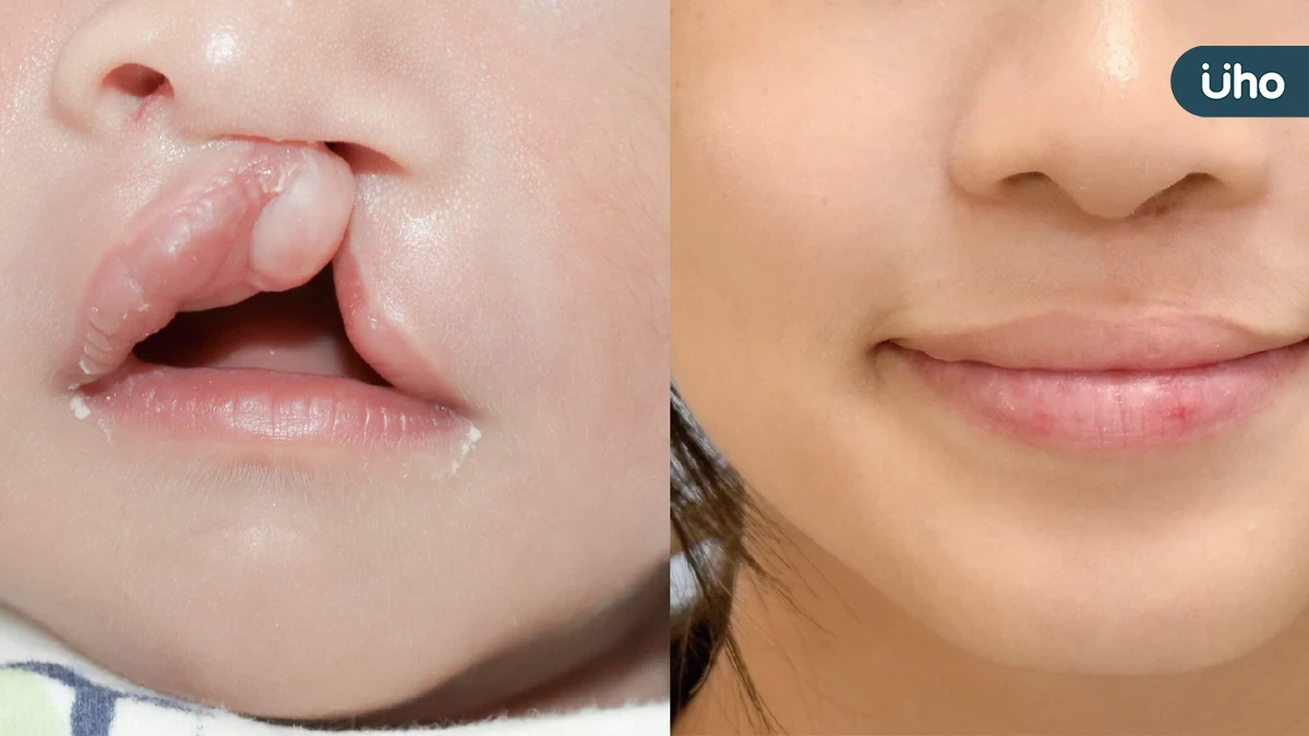 兔寶爸媽成長工作坊歷十屆有成 台灣唇顎裂產前診斷與產後治療典範轉移